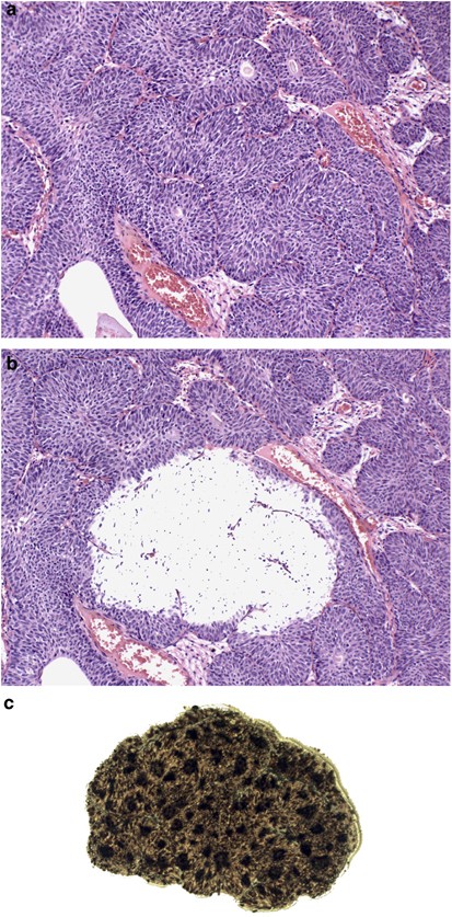 inverted papilloma of bladder pathology