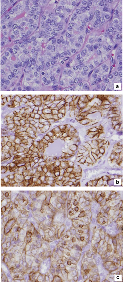 Immunohistochemical Markers In Diagnosis Of Papillary Thyroid Carcinoma Utility Of Hbme1 Combined With Ck19 Immunostaining Modern Pathology