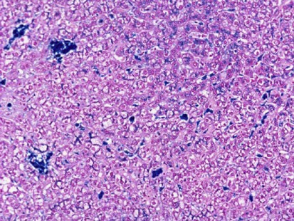 hemochromatosis histology