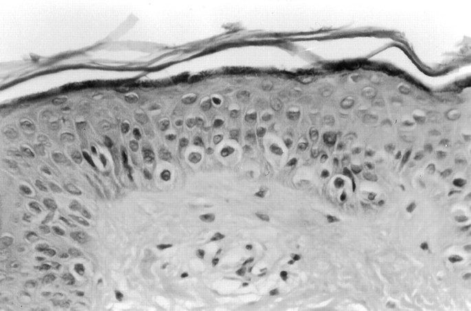 lentigenous melanotic hyperplasia Benign Atypical Junctional Melanocytic Hyperplasia Associated with  Intradermal Nevi: A Common Finding That May Be Confused with Melanoma In  Situ