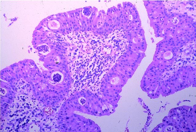 exophytic transitional cell papilloma