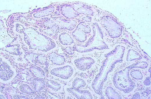 nasosinusalis papilloma erős paraziták kezelése