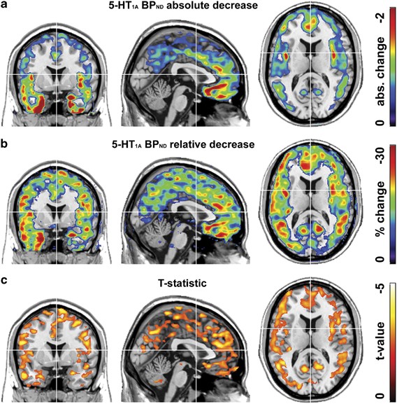 Global decrease of serotonin-1A receptor binding after electroconvulsive  therapy in major depression measured by PET | Molecular Psychiatry