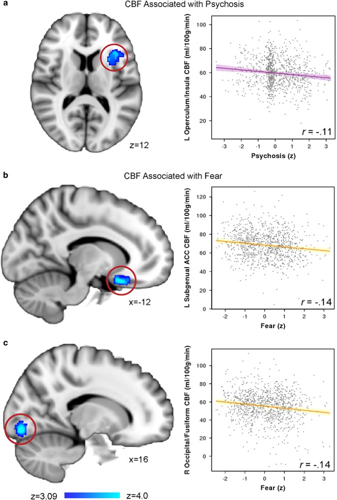 Common and dissociable regional cerebral blood flow differences ...