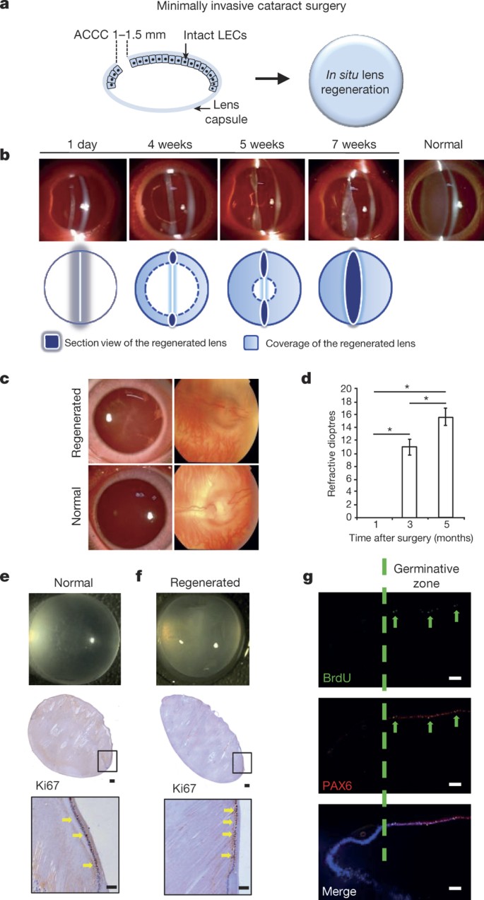 Lens regeneration using endogenous stem cells with gain of visual function  | Nature