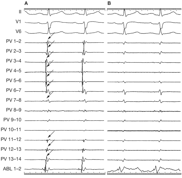 Technology Insight Catheter Ablation Of The Pulmonary Veins In The Treatment Of Atrial Fibrillation Nature Reviews Cardiology Technology Insight Catheter Ablation Of The Pulmonary Veins In The Treatment Of Atrial Fibrillation Nature Reviews Cardiology