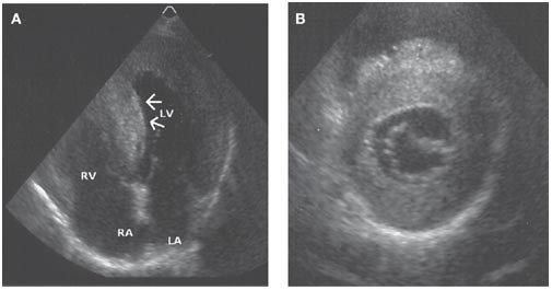 Echocardiography in Anderson-Fabry Disease