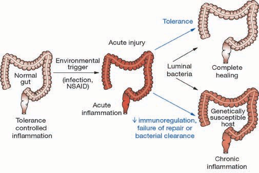 l carnitine ulcerative colitis Mechanisms of Disease: pathogenesis of Crohn's disease and ulcerative colitis