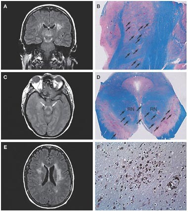 West Nile virus meningoencephalitis | Nature Reviews Neurology