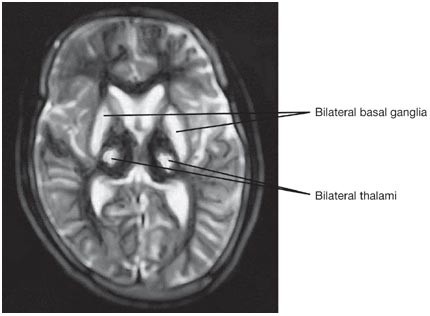 ghk-cu contraindicated wilson's disease Wilson's disease: an update ghk-cu contraindicated wilson's disease Wilson's disease: an update