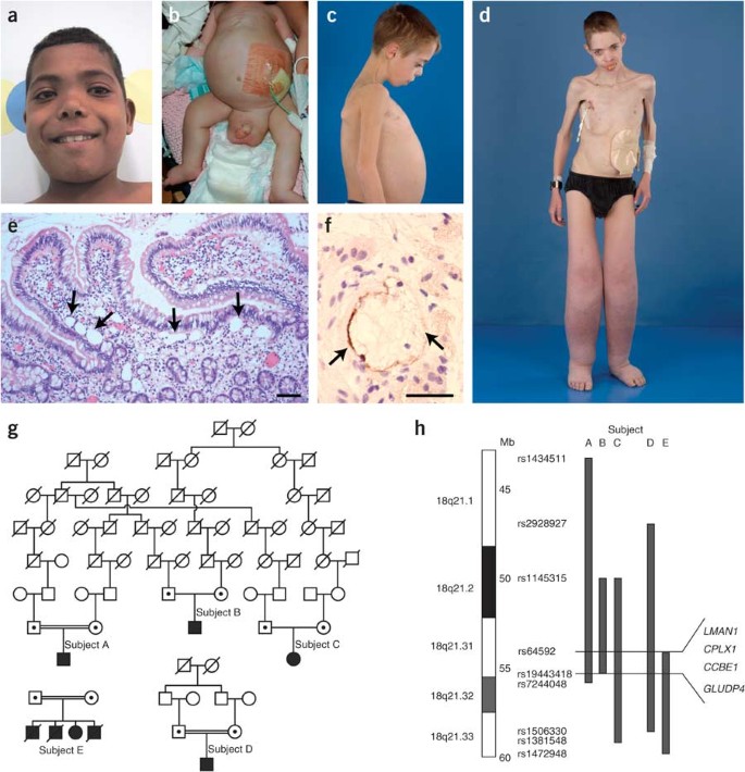 Mutations in CCBE1 cause generalized lymph vessel dysplasia in humans |  Nature Genetics