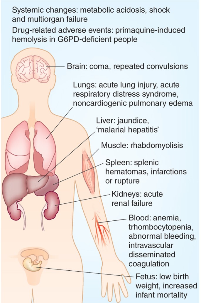 Defying malaria: Fathoming severe Plasmodium vivax disease | Nature Medicine Defying Malaria: Fathoming Severe Plasmodium Vivax Disease | Nature Medicine