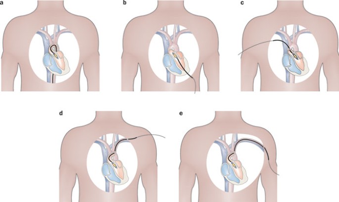 Transcatheter Aortic Valve Implantation Current And Future Approaches Nature Reviews Cardiology