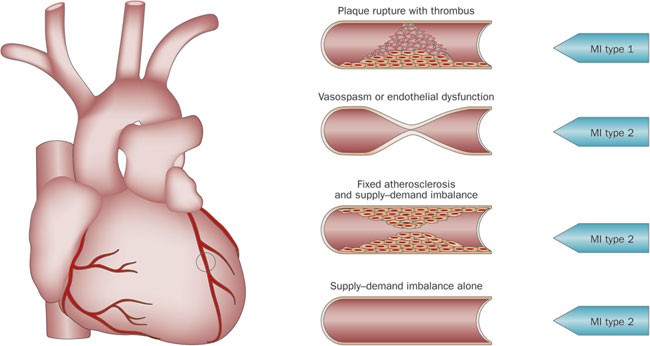 Infarction meaning