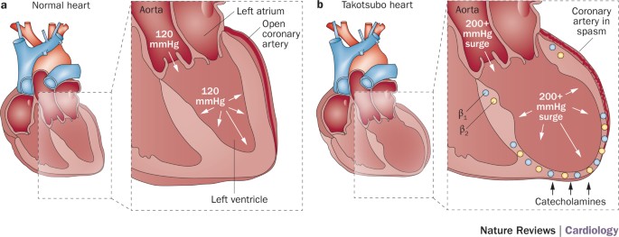 Familial apical dilated cardiomyopathy in a young man: a novel phenotype of  Takatsubo syndrome or a new entity altogether?