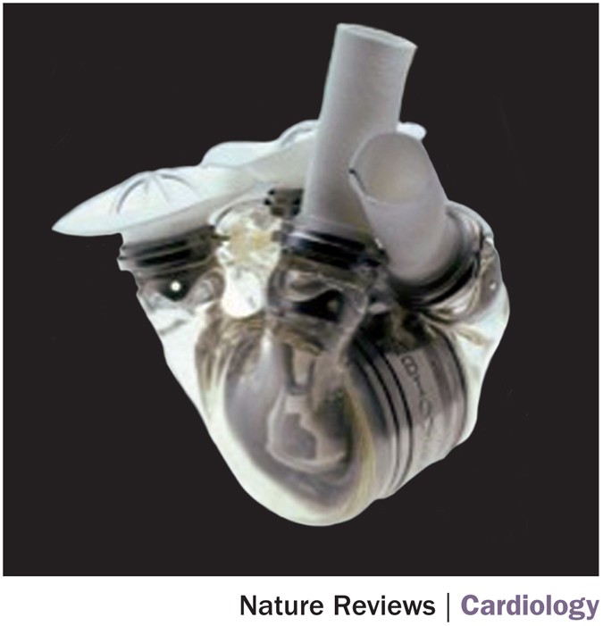 Total Artificial Heart: Procedure and Outlook