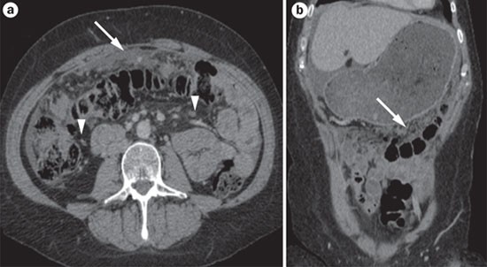 Imaging Ovarian Cancer And Peritoneal Metastases Current And Emerging Techniques Nature Reviews Clinical Oncology