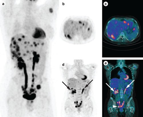 peritoneal cancer pet scan)