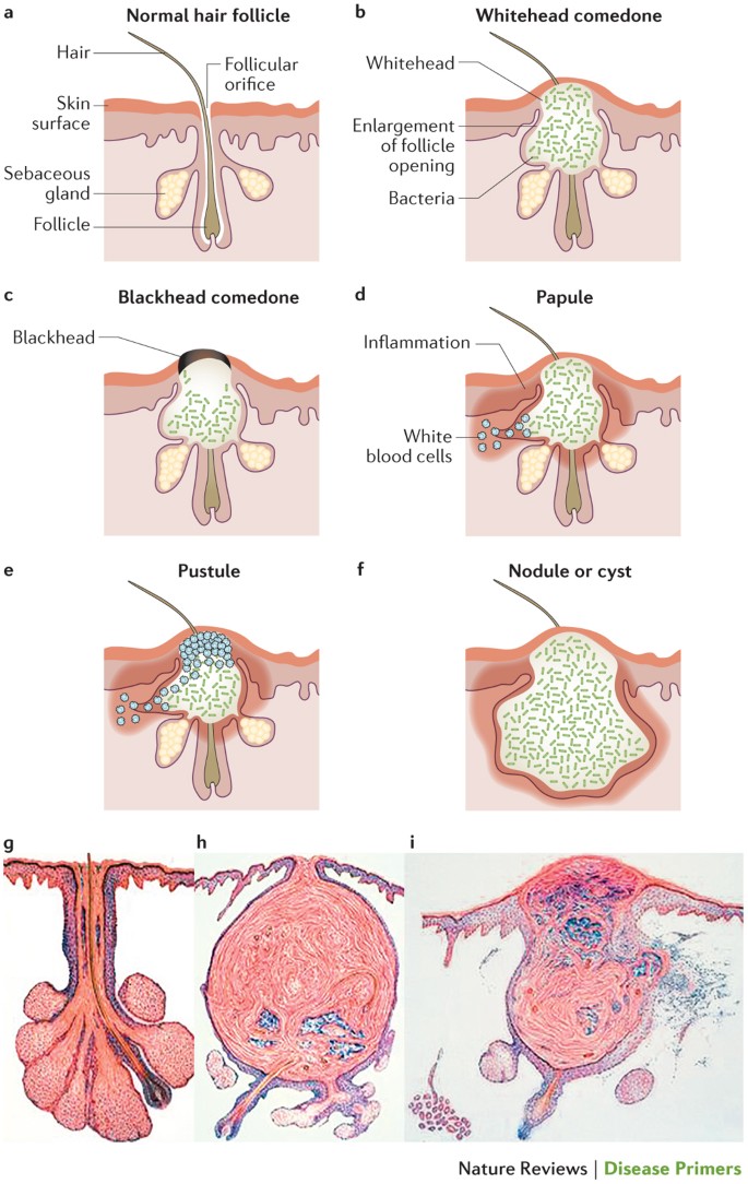 Acne vulgaris | Nature Reviews Disease Primers