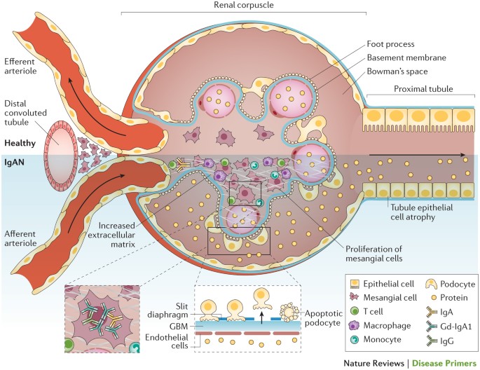 iga nephropathy nature reviews disease primers