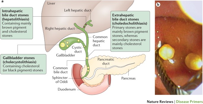 Gallstones Nature Reviews Disease Primers
