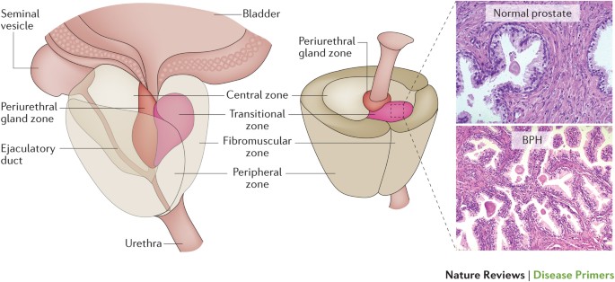 benign prostatic hyperplasia (bph) is characterized by ízületi és gerincbetegségek iskolája