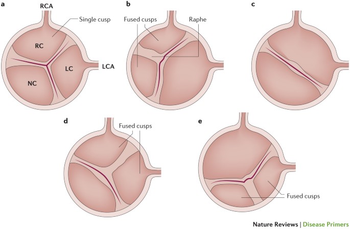 Calcific aortic stenosis | Nature Reviews Disease Primers