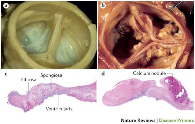 Calcific aortic stenosis | Nature Reviews Disease Primers