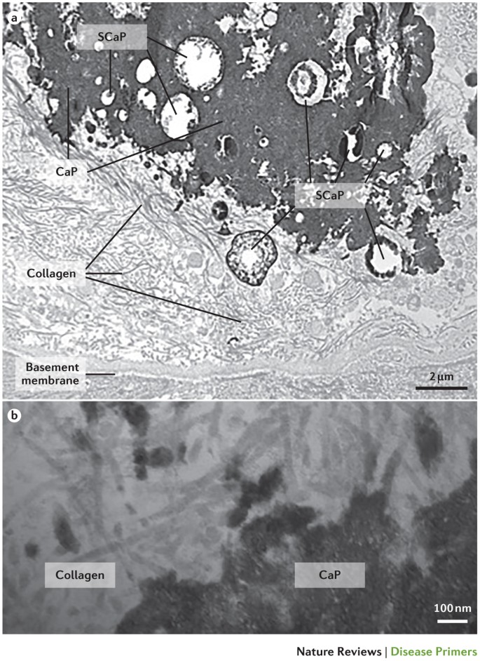 Kidney Stones Nature Reviews Disease Primers