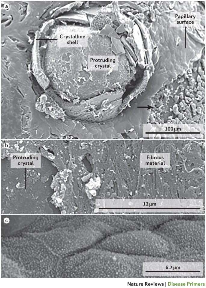 Kidney Stones Nature Reviews Disease Primers