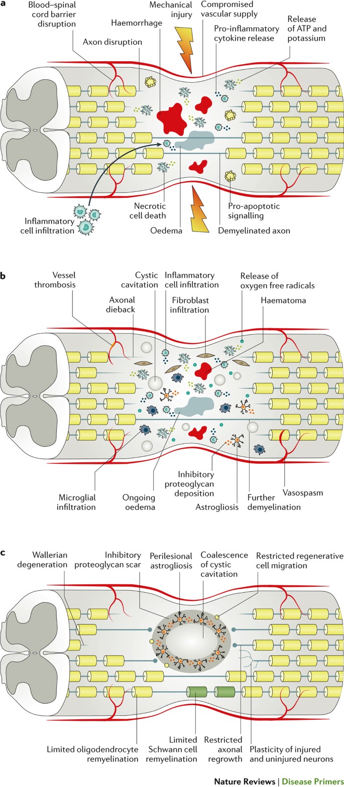 Traumatic spinal cord injury | Nature Reviews Disease Primers