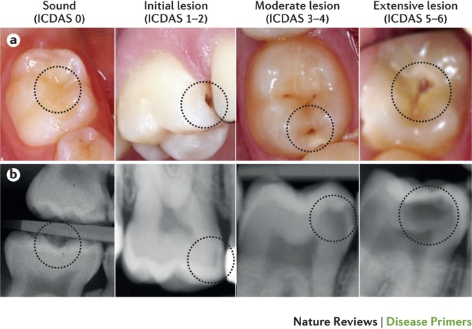 dental caries progression