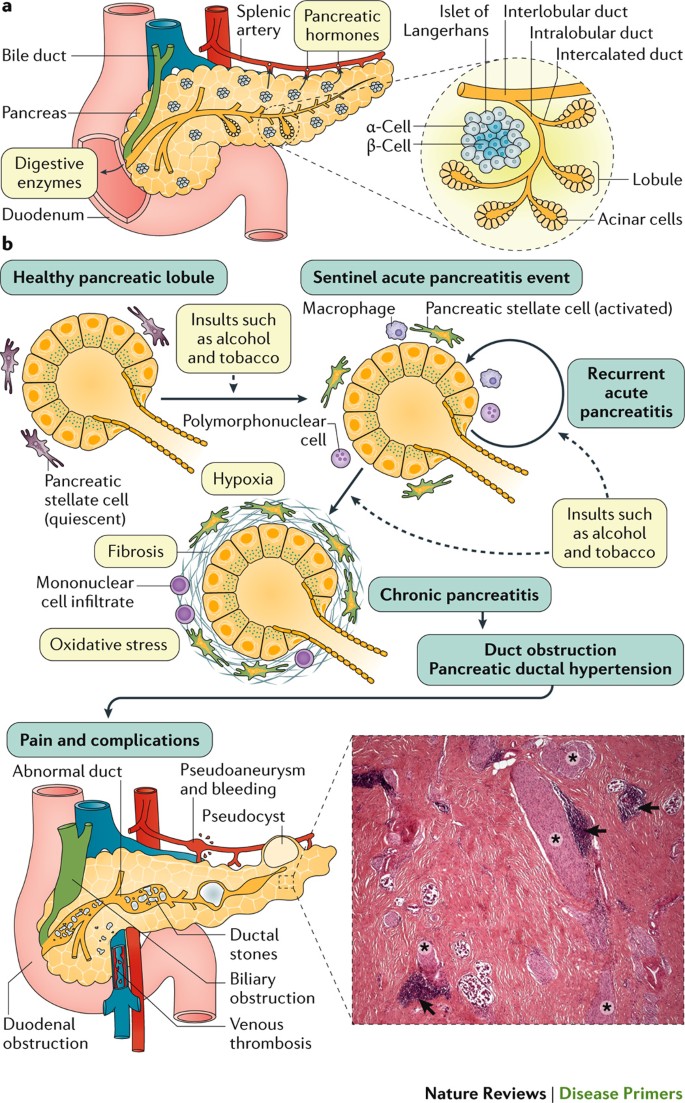 Chronic Pancreatitis | Nature Reviews Disease Primers