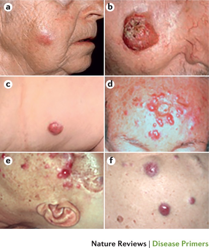 Merkel cell carcinoma | Nature Reviews Disease Primers