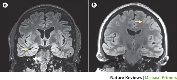 Epilepsy Nature Reviews Disease Primers - 
