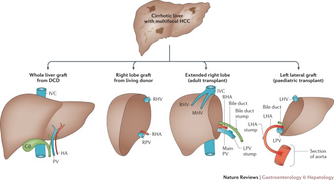 Liver Transplantation For Hepatocellular Carcinoma: Outcomes And Novel  Surgical Approaches | Nature Reviews Gastroenterology &amp; Hepatology