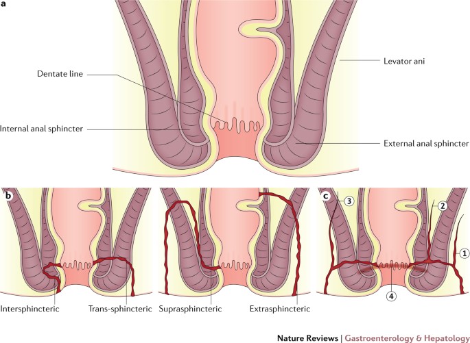 Perianal fistulizing Crohn's disease: pathogenesis, diagnosis and therapy |  Nature Reviews Gastroenterology & Hepatology