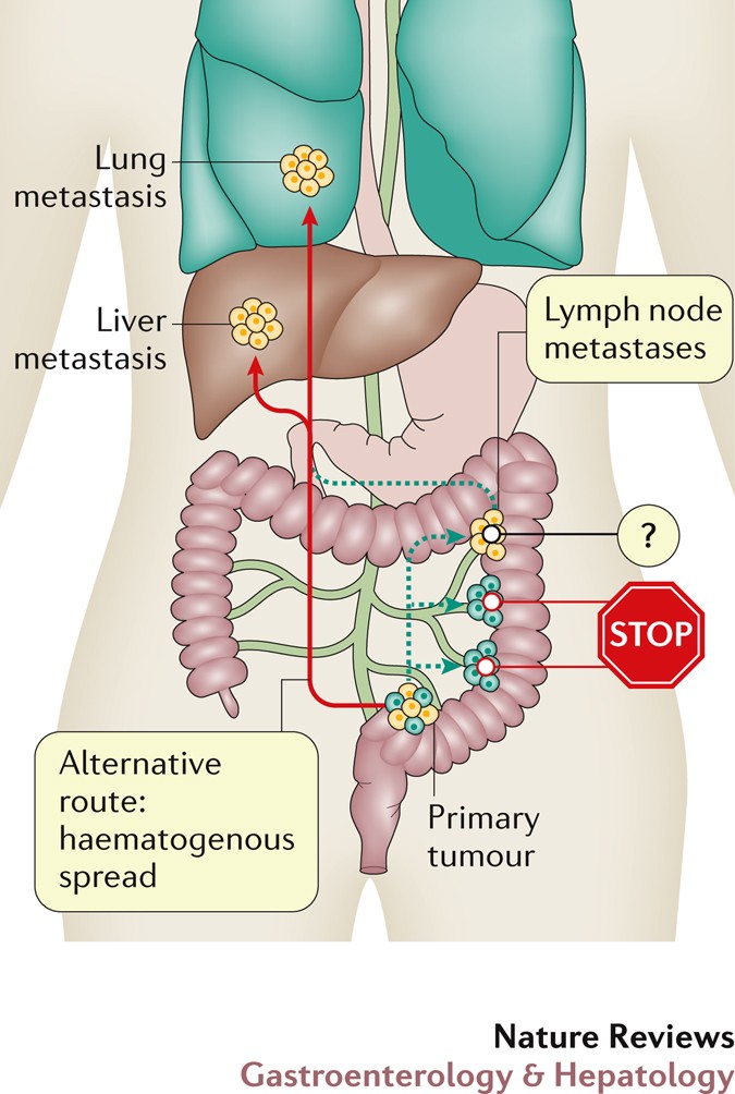 rectal cancer with mets)