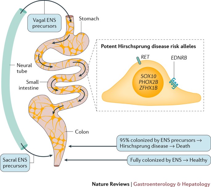 Hirschsprung Disease Integrating Basic Science And Clinical Medicine To Improve Outcomes Nature Reviews Gastroenterology Hepatology