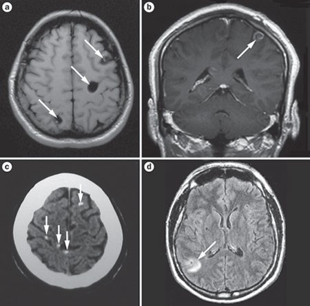 neurocysticercosis