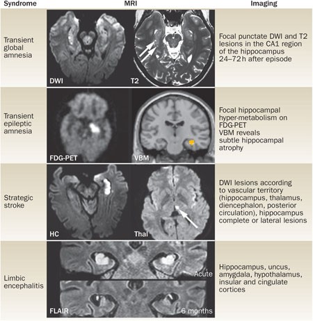 transient global amnesia emedicine