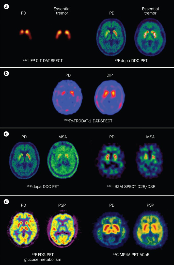 Neuroimaging in Parkinson disease: from research setting to clinical | Nature Reviews Neurology