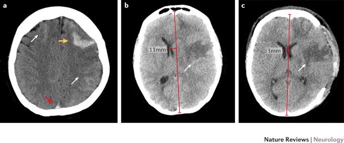 Cerebral Venous Thrombosis Nature Reviews Neurology