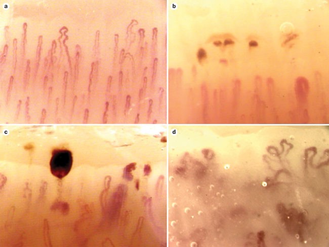 Assessing Microvascular Changes In Systemic Sclerosis Diagnosis And Management Nature Reviews Rheumatology Assessing Microvascular Changes In Systemic Sclerosis Diagnosis And Management Nature Reviews Rheumatology