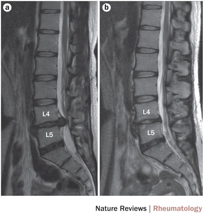 Stem Cell Therapy For Intervertebral Disc Regeneration: Obstacles And  Solutions | Nature Reviews Rheumatology