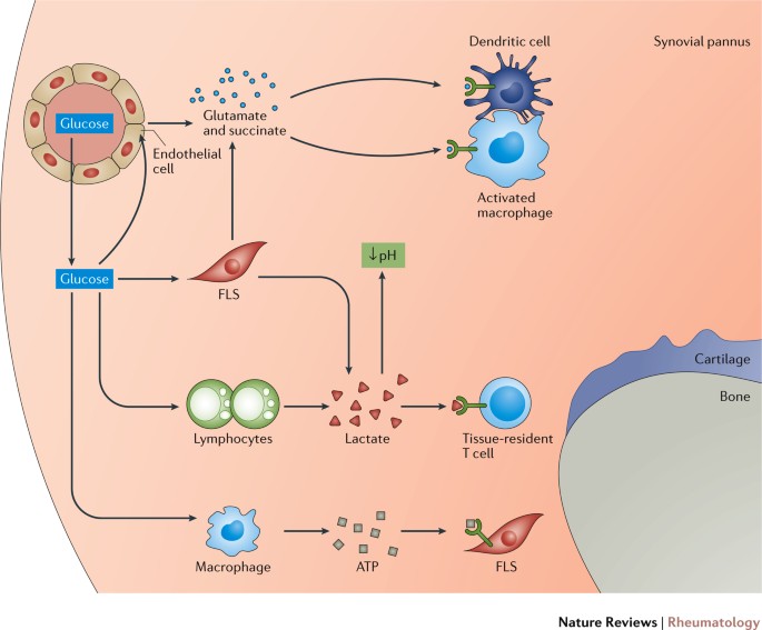 Immunometabolism in early and late stages of rheumatoid arthritis