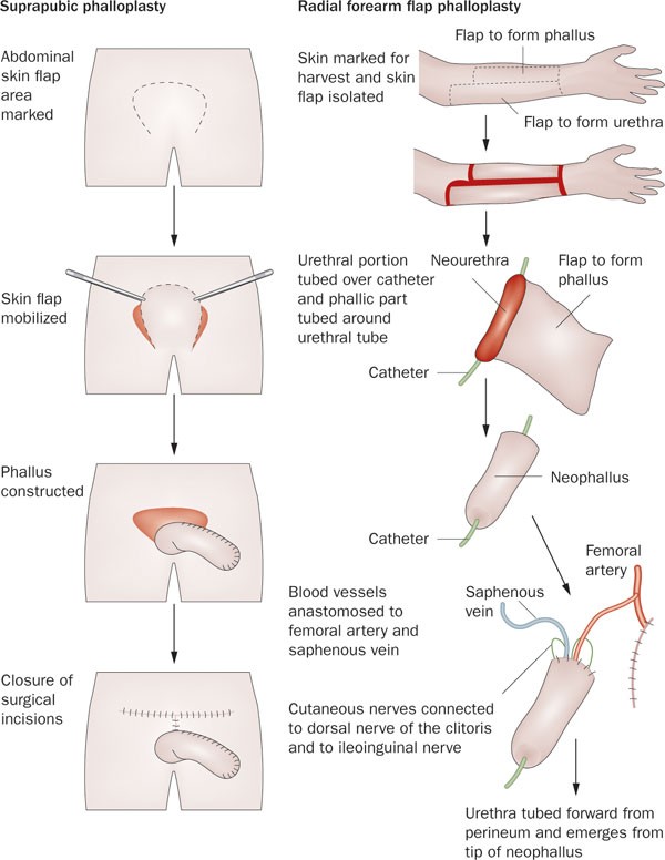 Gender reassignment surgery: an overview | Nature Reviews Urology