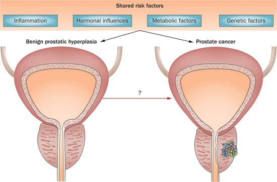 prostate enlargement and prostate cancer)