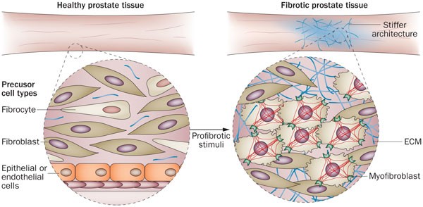 prostate fibrosis mi ez az