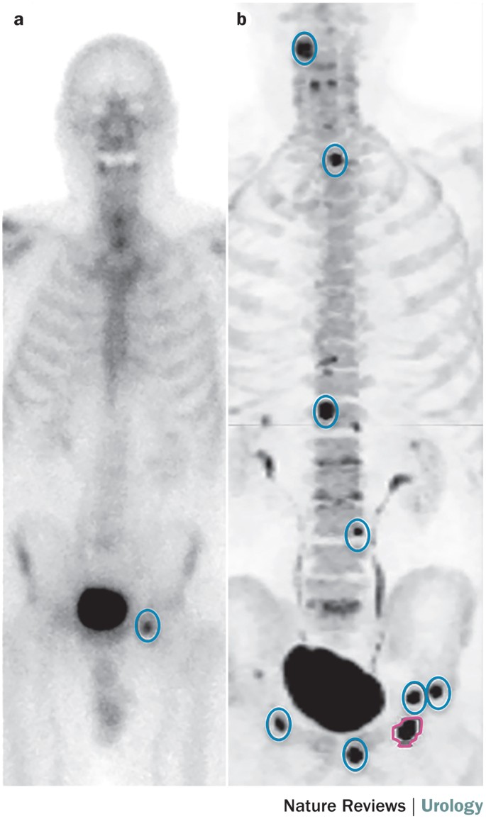 Imaging and evaluation of patients with high-risk prostate cancer | Nature  Reviews Urology, image size:685x1155